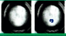 Original 30-hour nasal epithelial scratch-assay image pair for P&B active water ADW S-100, including the source’s blue gap overlay.